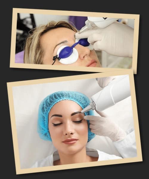 Видалення татуажу брів лазером: до та після