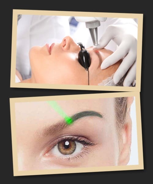 Переваги лазерного методу зведення татуажу