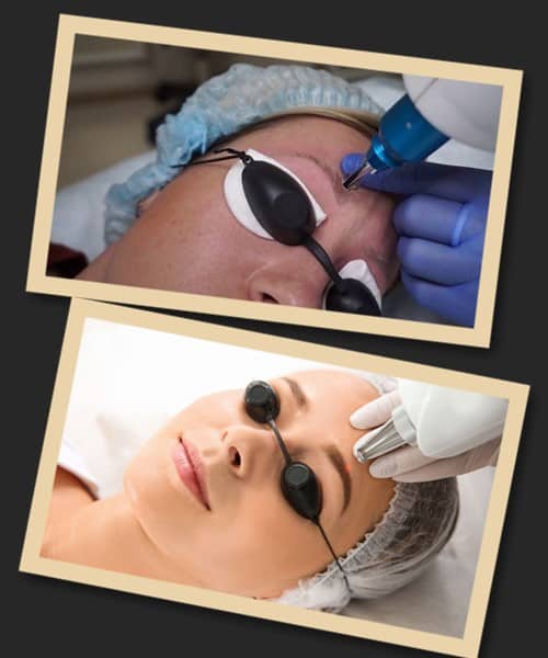 лазерне видалення татуажу брів