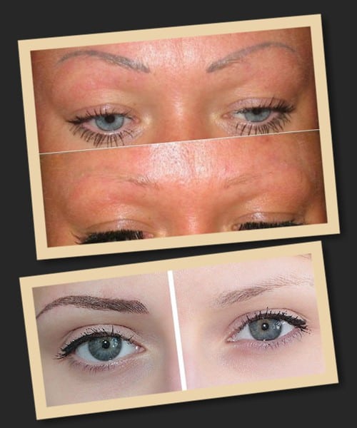 Особливості виведення татуажу ремувером