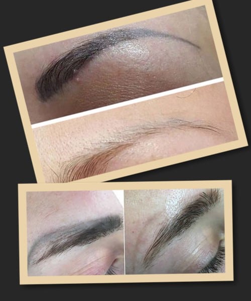 після видалення татуажу ремувером