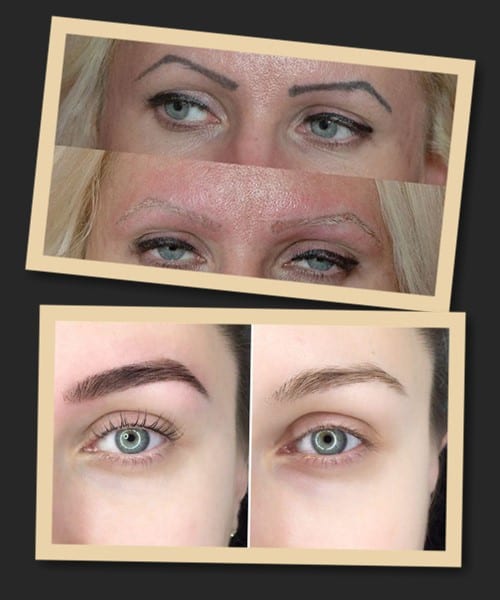 Видалення татуажу брів ремувером