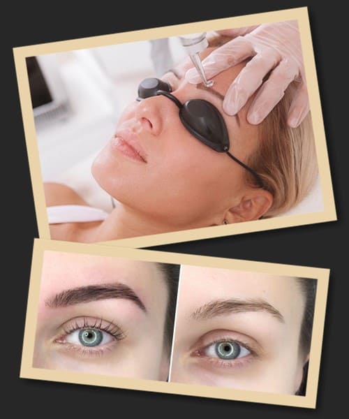 протипоказання до видалення татуажу