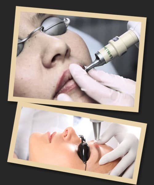 Видалення татуажу лазером