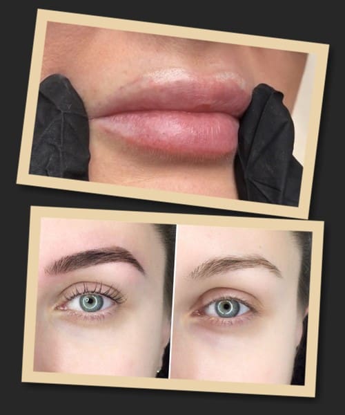 догляд після видалення татуажу ремувером