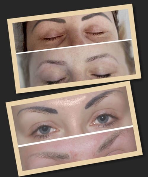 ремувер для видалення татуажу