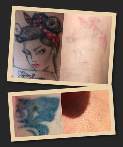 Як працює ремувер для видалення тату