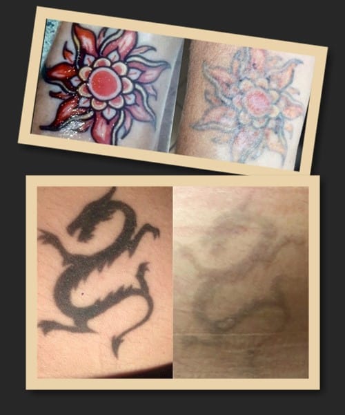 видалення тату ремувером