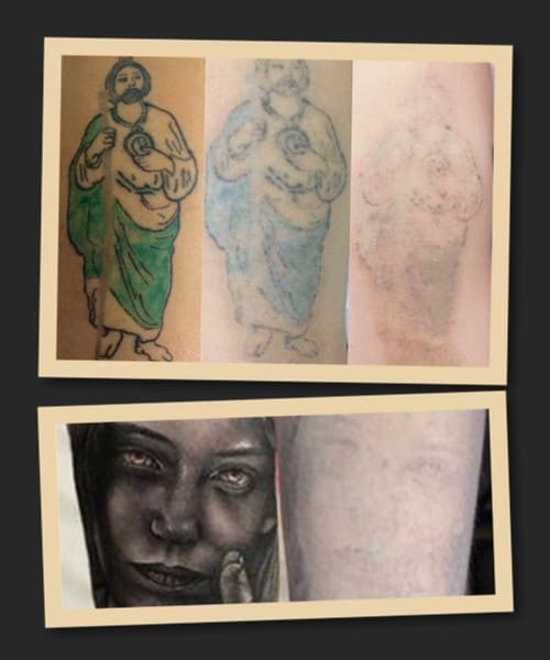 При видаленні татуювання ремувером