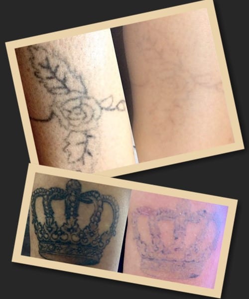 Видалення татуювань ремувером фото