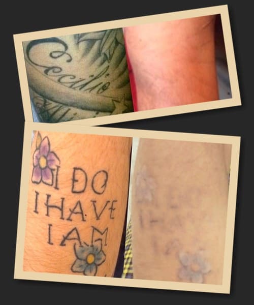 використання ремувера для зведення татуювань