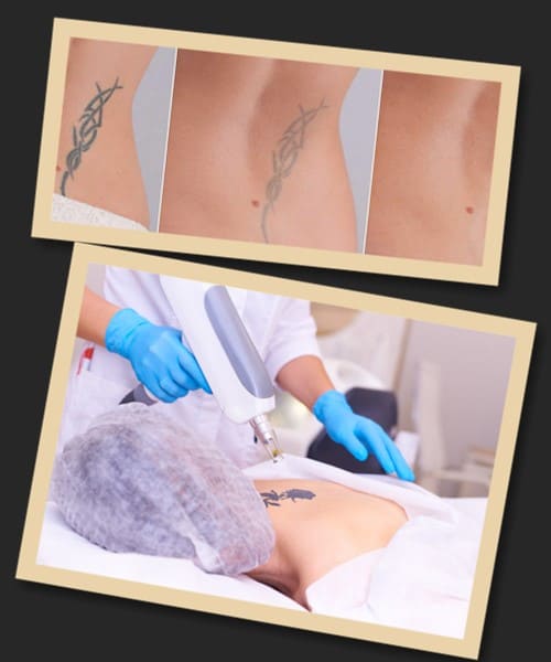 Видалення татуювання: до та після