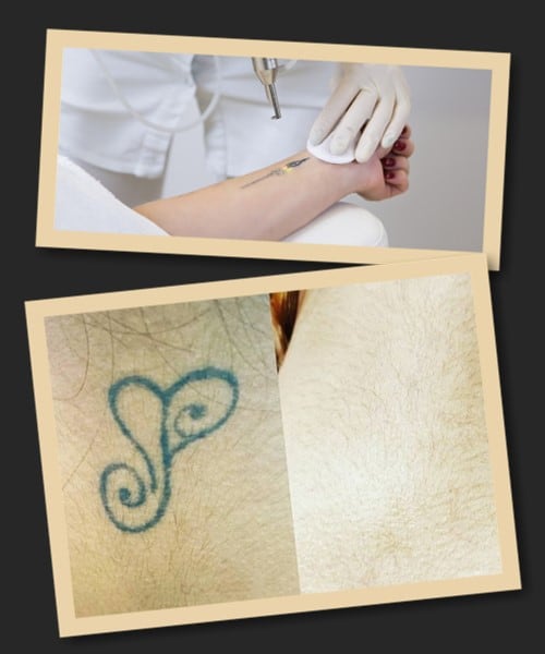 Методи виведення татуювань