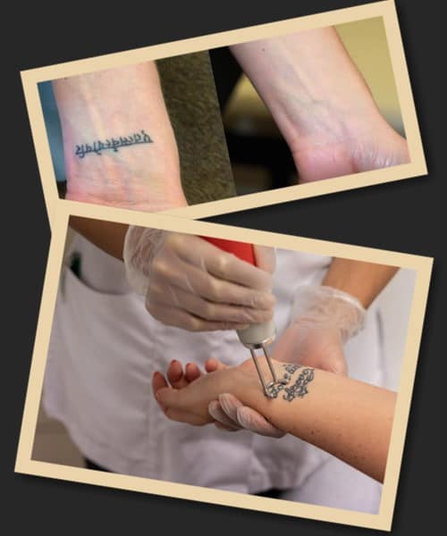 Переваги лазерної методики зведення тату