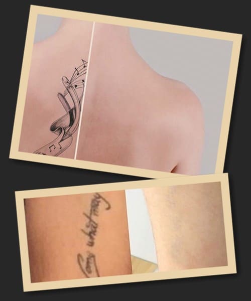 Лазерное удаление тату