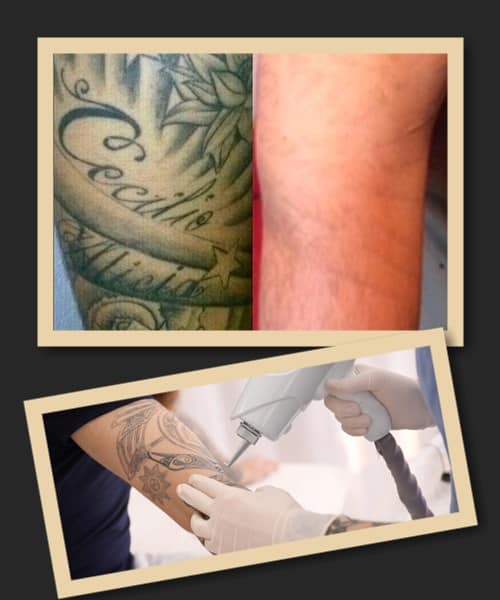 після зведення татуювання лазером