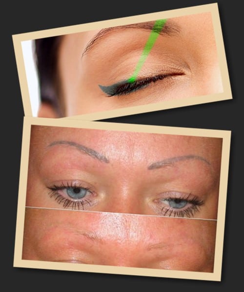 Видалення зеленого татуажу