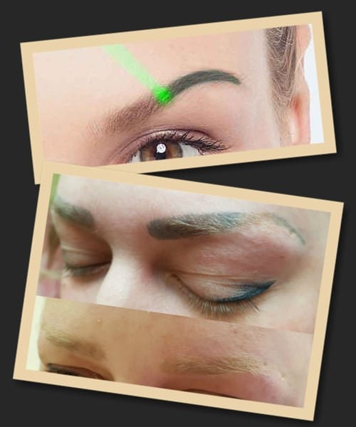 Видалення зеленого татуажу лазером