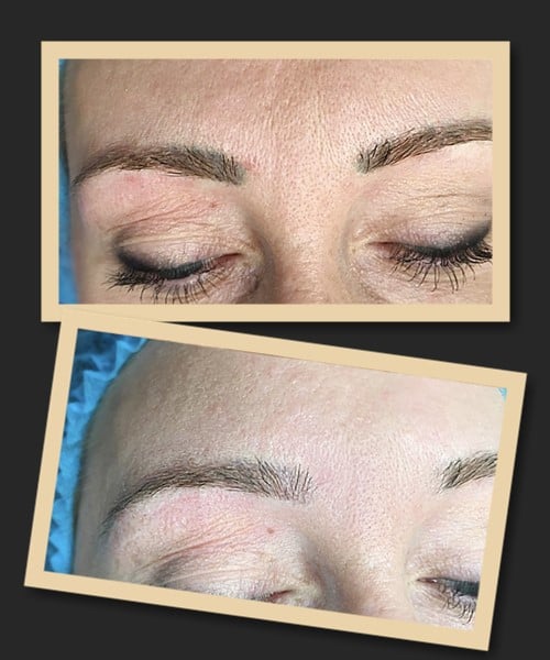 висвітлення татуажу лазером