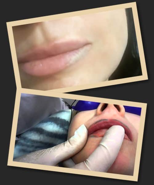 Видалення зеленого татуажу лазером