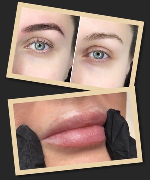 Виведення татуажу ремувером