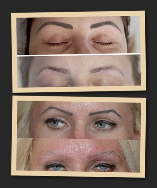 Видалення татуажу із застосуванням ремуверу