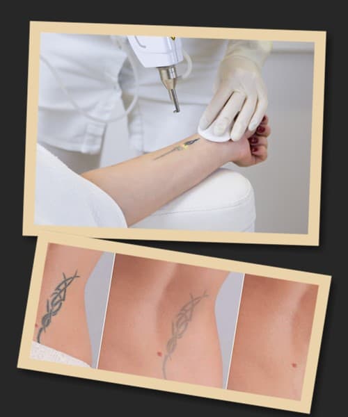 Виправлення татуювань у Києві