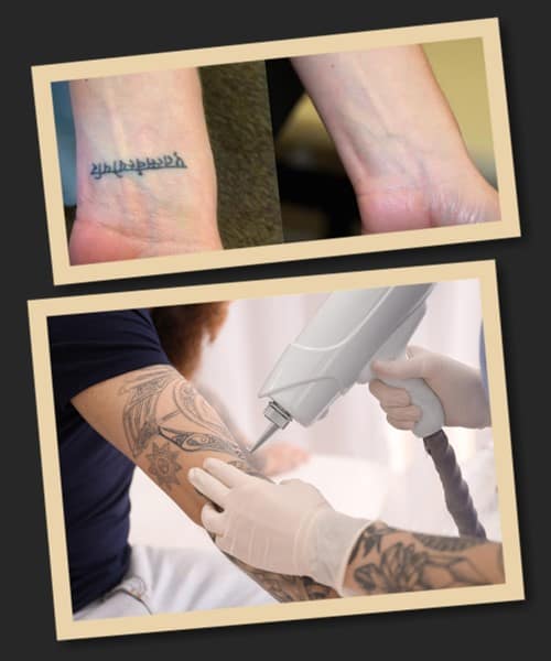 виправлення татуювань Київ