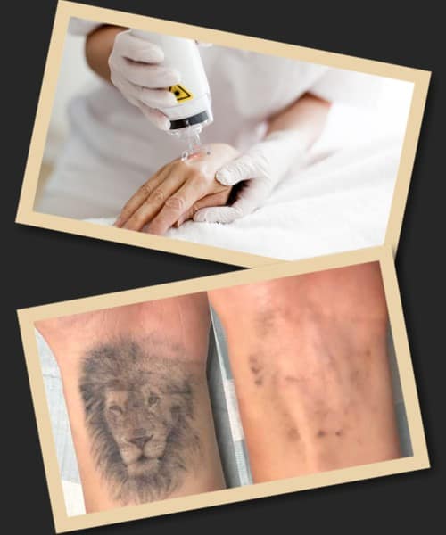 лазерне виправлення тату