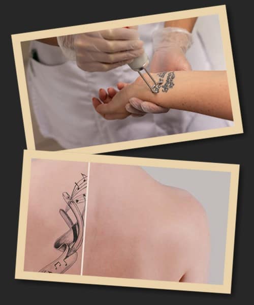 освітлити тату лазером