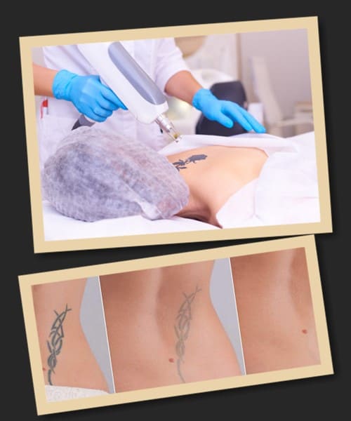 зведення тату лазером фото до та після