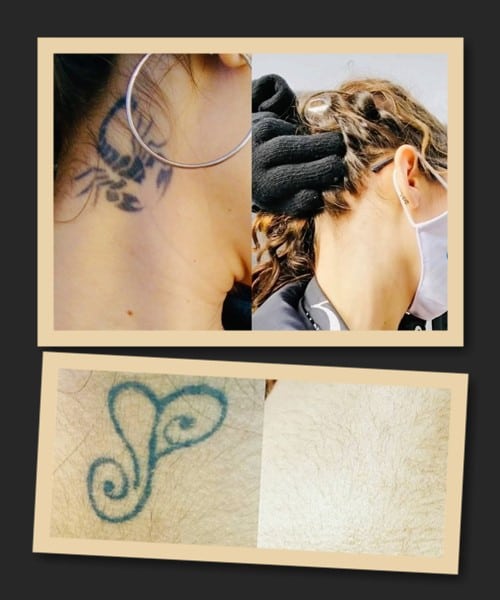 Способи зведення татуювань