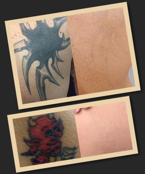 зведення тату лазером