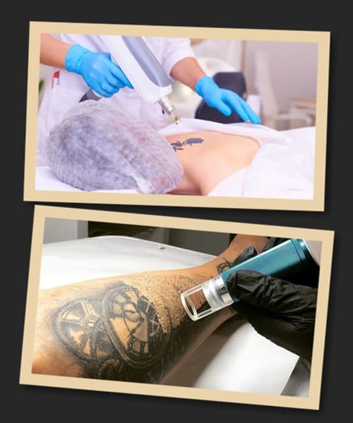 зведення татуювання лазером відгуки