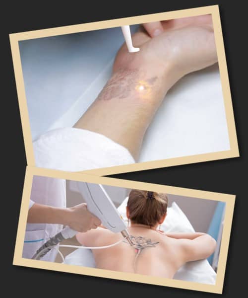 Хто видаляв татуювання лазером