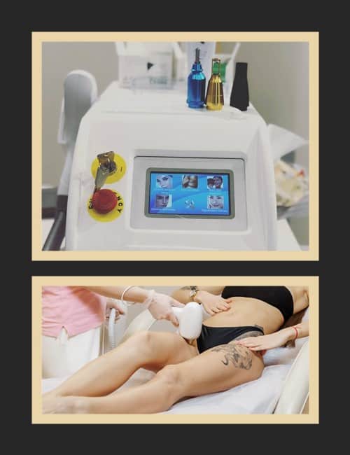 опік від лазерної епіляції на тату