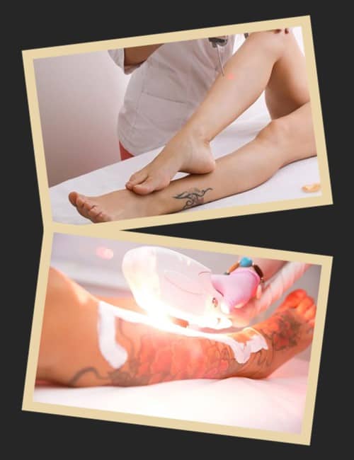 Виконувати лазерну епіляцію на ділянці шкіри, де нанесене татуювання