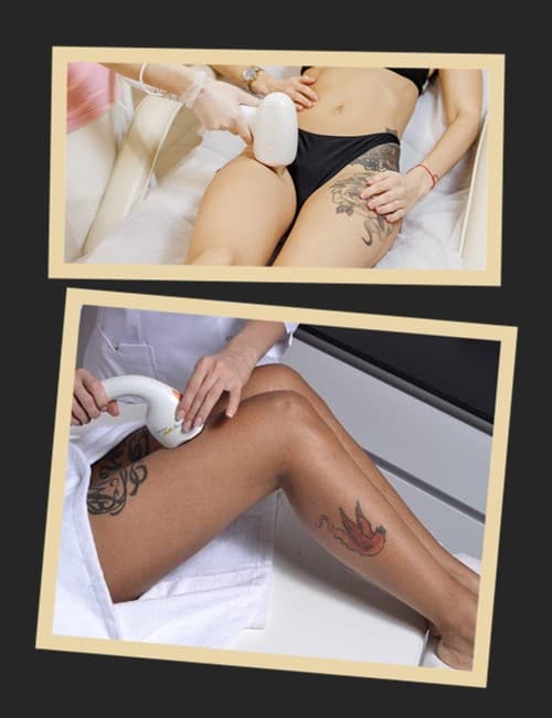 тату і лазерна епіляція