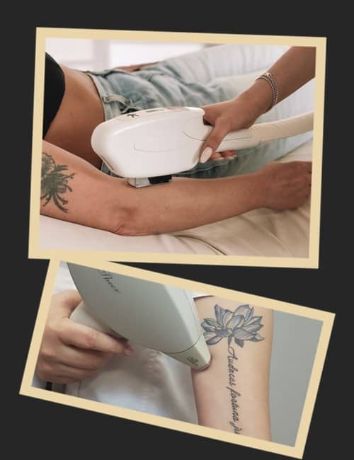 Чим відрізняється лазерна епіляція від лазерного видалення тату