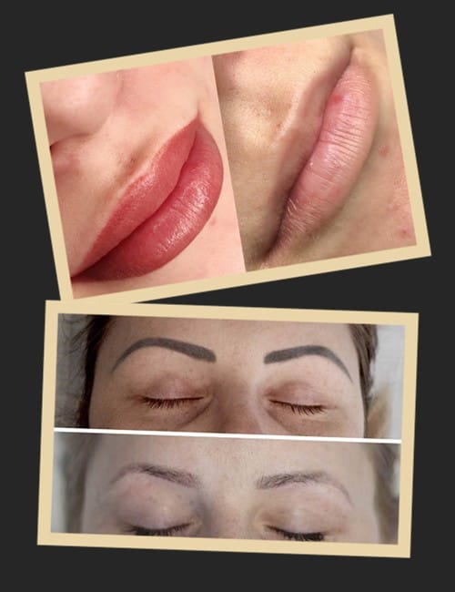 Ревайвінк та інші методи видалення татуажу