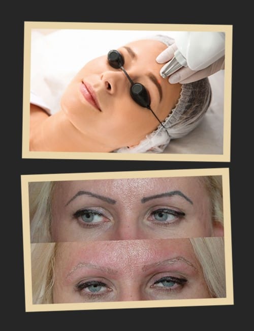 Методи видалення татуажу