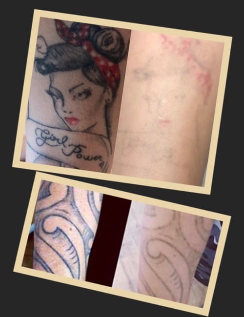 ремувер для видалення тату