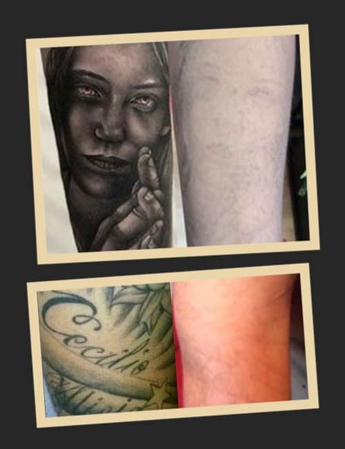 Видалення тату ремувером