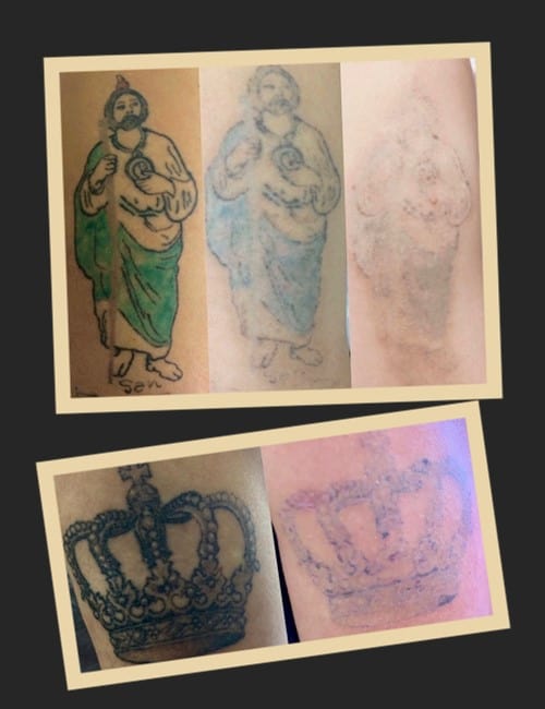 Фото видалення ремувером до та після