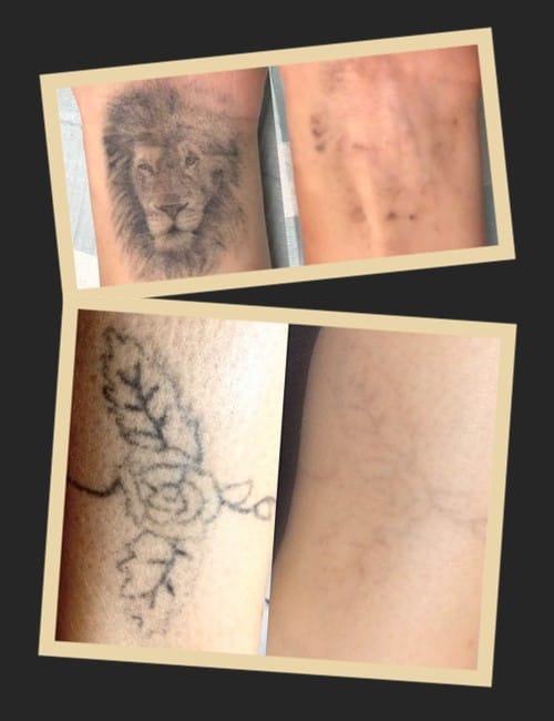 Хімічний метод виведення тату