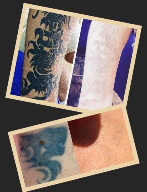 Як працює ремувер видалення тату