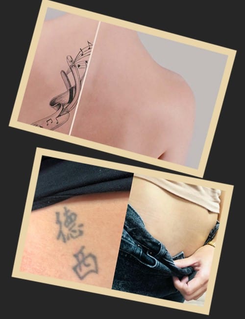 видалення тату до та після фото