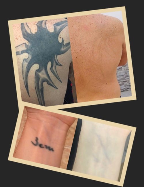 Коли татуювання краще видалити