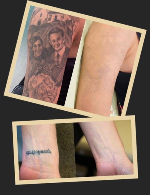 Який метод видалення тату – найбезпечніший