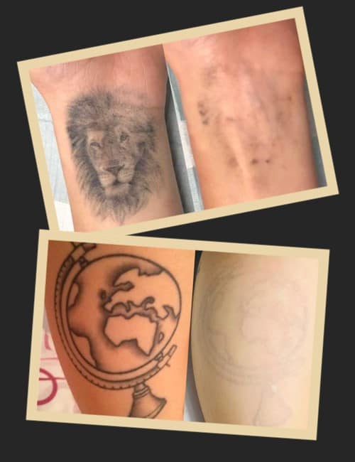 Лазерне видалення татуювань